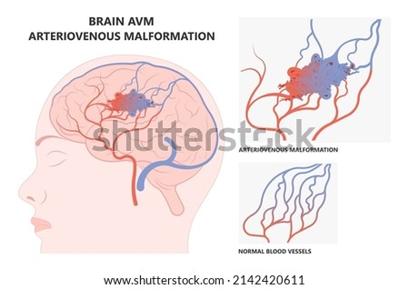 scalp brain ct scan X-ray image mri diagnose Blood AVM artery veins flow stroke Loss of optic nerve pain head galen swelling tangle capillaries system nidus cerebral attack Transient dural fistula