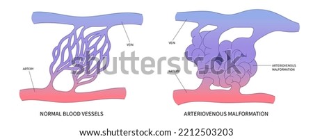 scalp brain ct scan X-ray image mri diagnose Blood AVM artery veins flow stroke Loss of optic nerve pain head galen swelling tangle capillaries system nidus cerebral attack Transient dural fistula