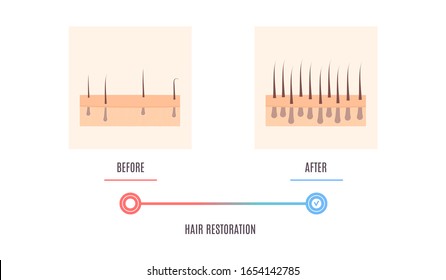 Scalp Close Up Of Hair Follicles Before And After Alopecia Treatment. Skin Cross-section Medical Diagnostics Diagram. Hair Loss Treatment And Transplantation Concept. Vector Illustration.