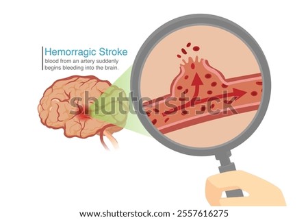Scan brain with Magnifying glass for looking artery in brain with bleeding. Illustration about Hemorrhage Stroke cause of dead or apoplectic.