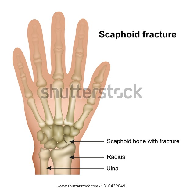 Scaphoid bone fracture medical vector\
illustration on white\
background