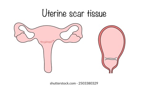 Cicatriz fuera y dentro del útero después de una cesárea. Una sección alterada de la pared uterina, formada después de que se dañó durante la cirugía. Ilustración vectorial médica.