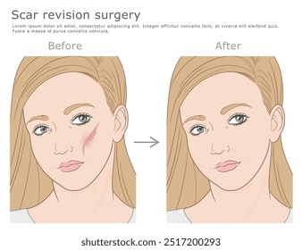 Ilustração de vetor de cirurgia de revisão de cicatriz. Antes e depois. Ilustração médica de cirurgia estética plástica.