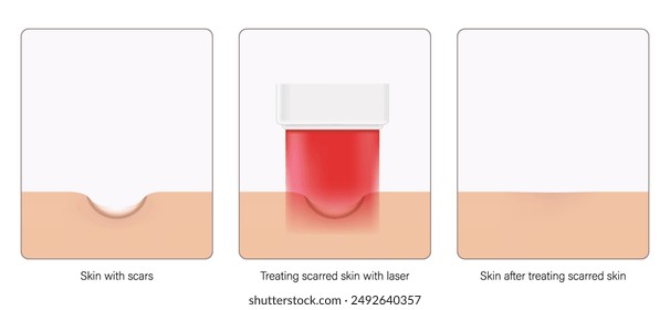 Scar treatment laser vector. Steps of before, during and after laser scar treatment. 