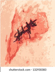The Scar. Vector illustration.
