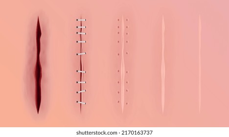 Scare seams realistic set of isolated icons with views of bloody abrasions stitching and skin regeneration vector illustration