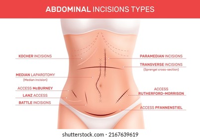 Scares Injures Seams Realistic Infographics With View Of Female Body With Traces Pointers And Text Captions Vector Illustration