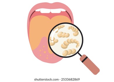 Escarlatina, infección bacteriana causada por Streptococcus pyogenes, marcada por una erupción roja, dolor de garganta y fiebre. faringitis estreptocócica. , fiebre reumática, impétigo.