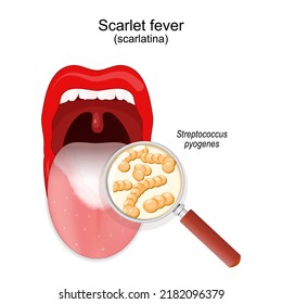 Scharlach-Fieber. Mund der Kinder mit Krankheitssymptomen auf der Zunge. Nahaufnahme der Kolonie von Streptococcus pyogenes. Vergrößerung von Glas und Bakterien, die durch Scharlatina verursacht werden. Vektorgrafik