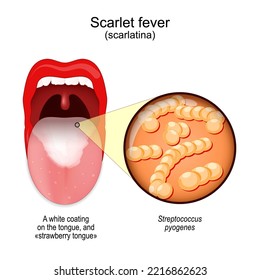 Fiebre escarlata. síntomas de la scarlatina. Boca con recubrimiento blanco sobre la lengua y "lengua de fresa". Cierre de Streptococcus pyogenes. Bacterias que causan esta enfermedad. Afiche del vector