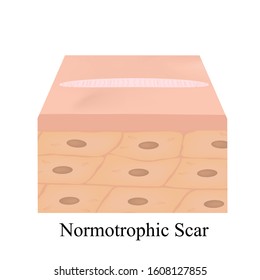 Scars normotrophic. The anatomical structure of the skin scar. Vector illustration on isolated background.