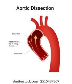 Diagrama esquemático da disseção da aorta