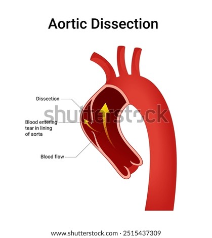 Schematic Diagram of Aortic Dissection