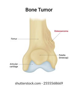 Schematic Diagram of Bone Tumor