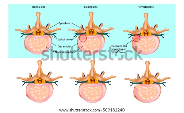 Schematic Drawing Hernia Disc Slipped Disc Stock Vector (Royalty Free ...