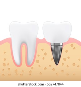 Schematic illustration of dental prosthetics, denture, side view