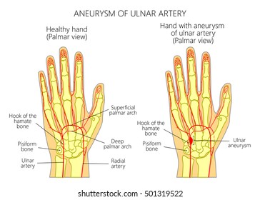 A schematic illustration of post-traumatic ulnar artery aneurysm located adjacent to the hamate bone.