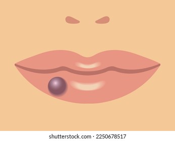 Ilustración esquemática de la lesión vascular benigna de la piel, llamada Lago Venoso, una pápula azul o púrpura blanda aplastable.