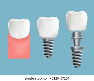 Schematic infographics of human teeth and dental implant. Stock vector illustration.