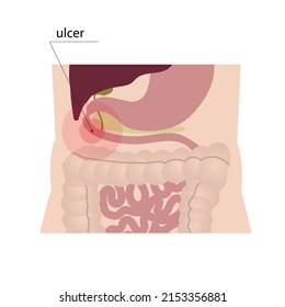 Representación esquemática de una úlcera duodenal