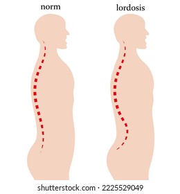Schematic representation of lordosis, curvature of the spine. Vector illustration