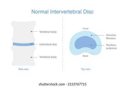 Schematic representations of the normal intervertebral disc. Illustration of medical diagram for the bone spine.