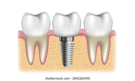 Schematic sectional view of a dental implant