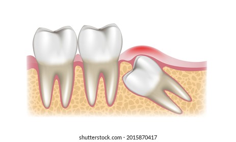 A schematic sectional view of a growing wisdom tooth