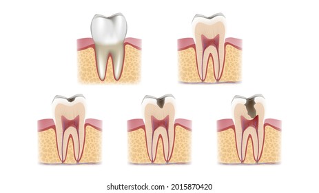A schematic sectional view of the stages of caries development on a tooth