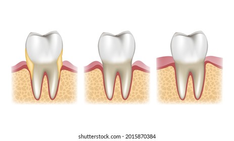 Schematic sectional view of the stages of treatment of a tooth with calculus