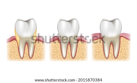 Schematic sectional view of the stages of treatment of a tooth with calculus
