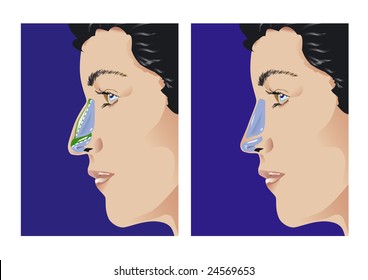 Schematic sketch of rhinoplasty. Elements are on a separate layer and can be easily removed. Gradients only (no transparencies)