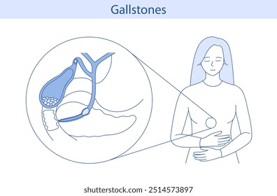 Schematic vector illustration of the structure of the gallbladder with stones.