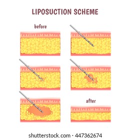 scheme of cosmetic surgery, liposuction illustration stages via cannula, leather sectional and fat removal