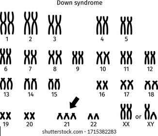 Scheme of Down syndrome karyotype of human somatic cell 47XX+21 and 47XY+21