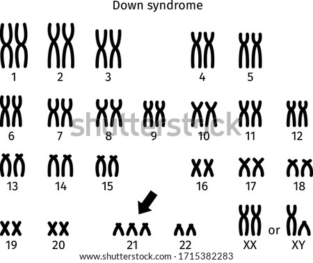 Scheme of Down syndrome karyotype of human somatic cell 47XX+21 and 47XY+21