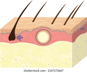 scheme of epidermal cyst with skin, skin pseudotumor, vector, graphic, vector illustration