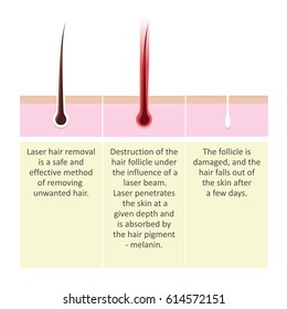 Scheme of laser hair removal. Setup Description of the cosmetology procedure.