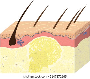 scheme of liposarcoma with skin, malignant tumor of adipose tissue from lipoma, vector, graphic, vector illustration svg