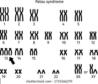 Scheme Of Patau Syndrome Karyotype Of Human Somatic Cell 47XX+13 And 47XY+13