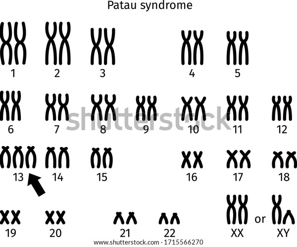Scheme Patau Syndrome Karyotype Human Somatic Stock Vector (Royalty ...