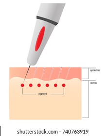 The scheme of the procedure of permanent makeup.