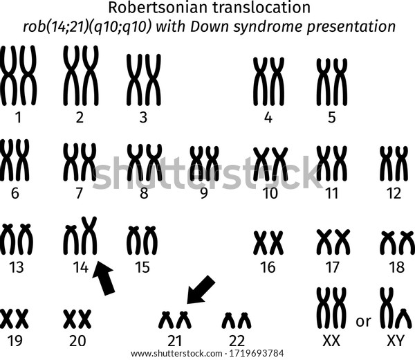 Scheme Robertsonian Thanslocation Clinical Presentation Down Stock ...