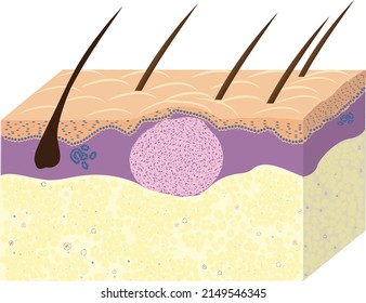 Scheme Of Skin Fibroma, Histology, Vetcor