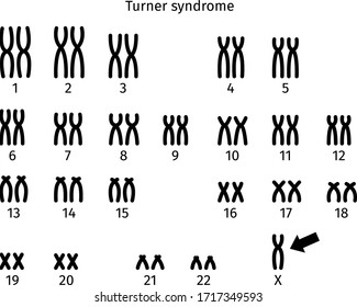 Scheme of Turner syndrome. karyotype of human somatic cell 45X0