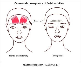 The scheme of young girl's face with stressed facial muscles. Worry lines on the forehead