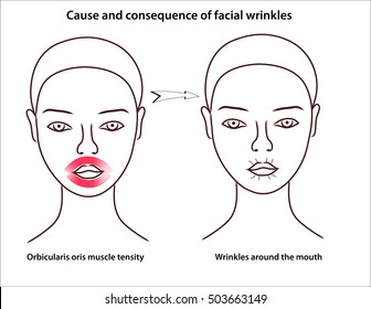 The scheme of young girl's face with stressed facial muscles.  Small wrinkles around the mouth.