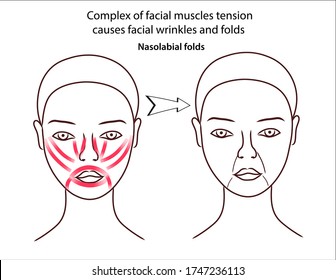 The scheme of young girl's face with tension of facial muscles which causes nasolabial folds