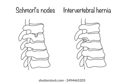 Schmorl's nodes and Intervertebral hernia. A disease in which the intervertebral disc protrudes in a vertical plane or the displacement of a deformed intervertebral disc. Medical vector.