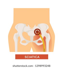 Sciatic back pain sciatica hip bone disease skeletal system inflammation vector human body part anatomy medicine and treatment trauma or injury vertebral ache and discomfort isolated skeleton bottom.
